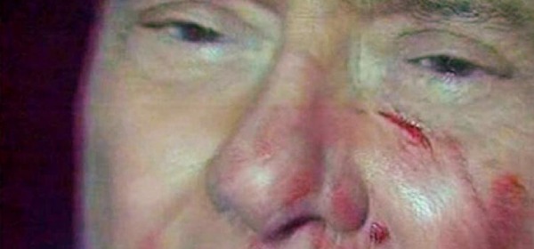 Silvio Berlusconi ferito da Massimo Tartaglia